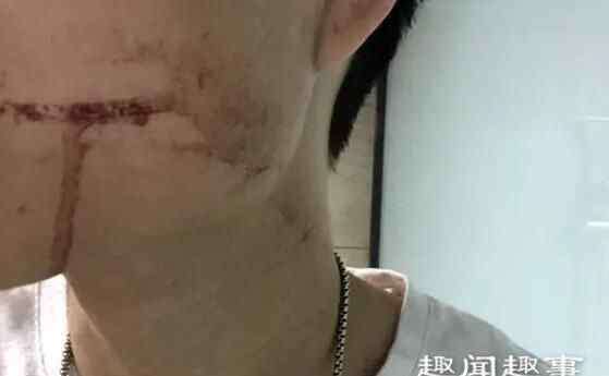 拔牙后出血 26岁小伙拔牙后出血不止10天后脑出血死亡 原因是这样实在吓尿了