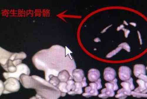 寄生胎 男婴腹中藏寄生胎 寄生胎什么意思可以存活吗