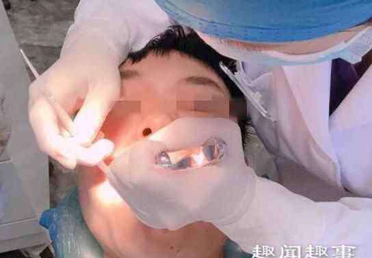 拔牙后出血 26岁小伙拔牙后出血不止10天后脑出血死亡 原因是这样实在吓尿了