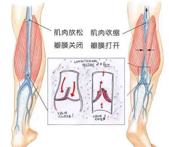腿部静脉曲张该怎么办 针对跑者小腿静脉曲张 你该怎么办？