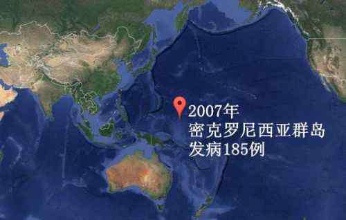 防病毒卡 关于寨卡病毒你必须知道的：有什么症状临床表现