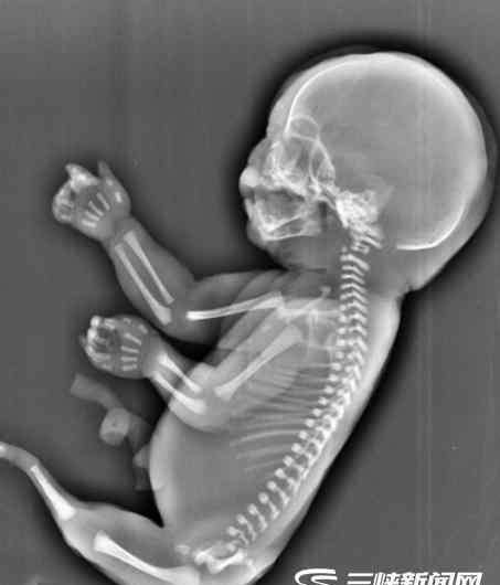 人鱼胎儿 23岁妈妈怀上人鱼宝宝 美人鱼综合症婴儿生存率极低