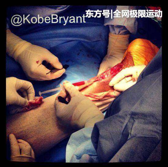 科比跟腱撕裂 血腥！科比跟腱断裂有多痛，手术过程告诉你！