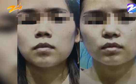 歪鼻整容 杭州甄美整形医院把人鼻子整歪了？医院：自己长歪了