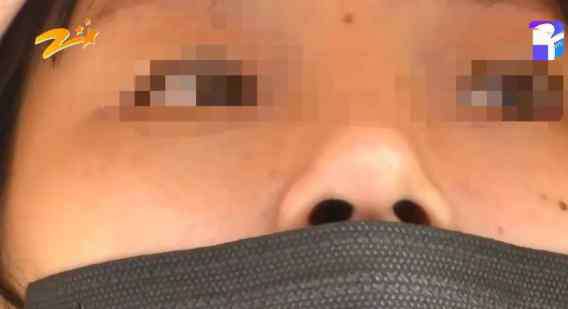 鼻梁歪整形手术 杭州甄美整形医院把人鼻子整歪了？医院：自己长歪了