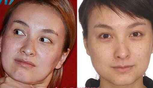 吴昕整容 吴昕整容了吗 吴昕整容前后对比照片