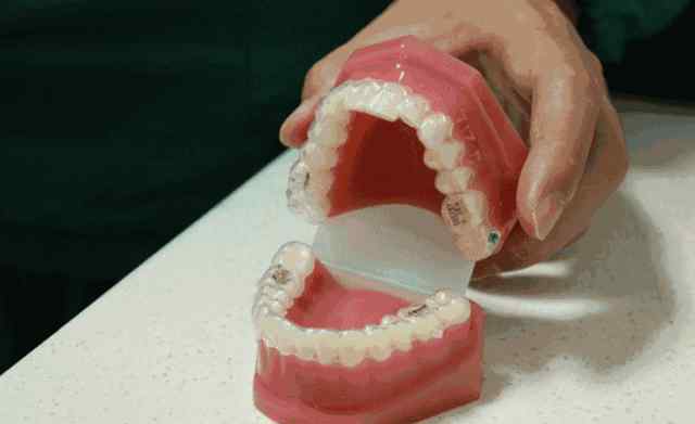 牙齿反弹有补救办法吗 牙齿矫正会反弹？还有补救的方法！