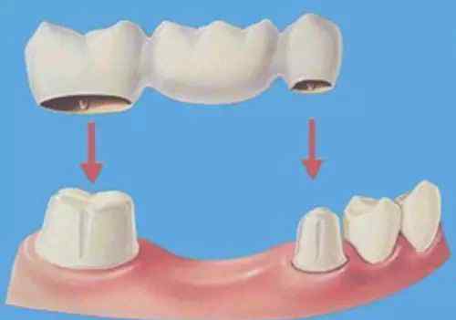 镶牙不磨两边的牙行吗 为什么镶牙的时候要磨掉两边好的牙齿？
