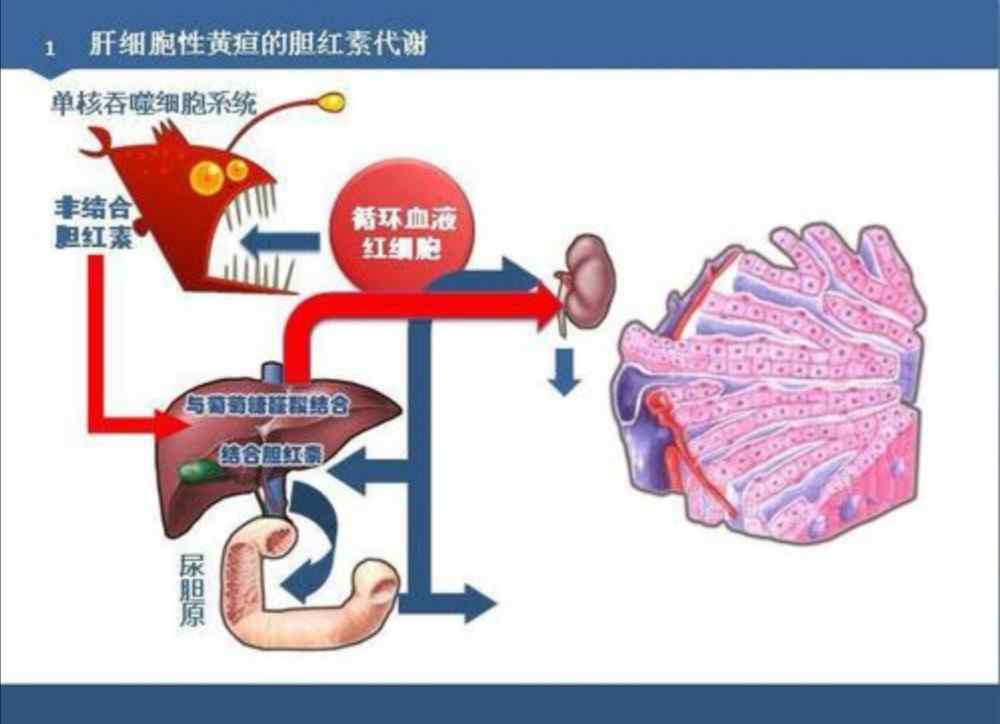 肝细胞性黄疸 肝细胞性黄疸