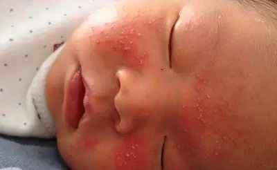 新生儿湿疹如何处理 宝宝湿疹怎么办？最靠谱的解决方法在这里！