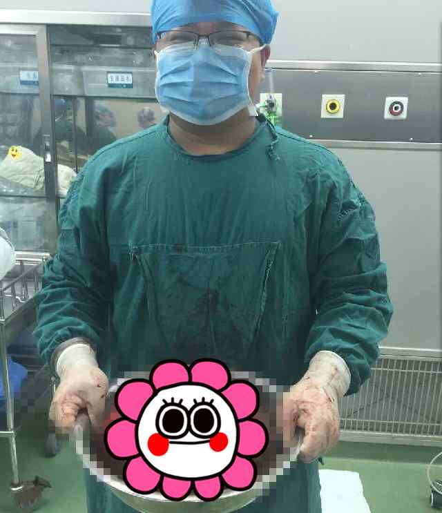 一个礼拜减掉啤酒肚 金华一爱喝酒大伯腹大如球 医生取出近10斤的肿瘤