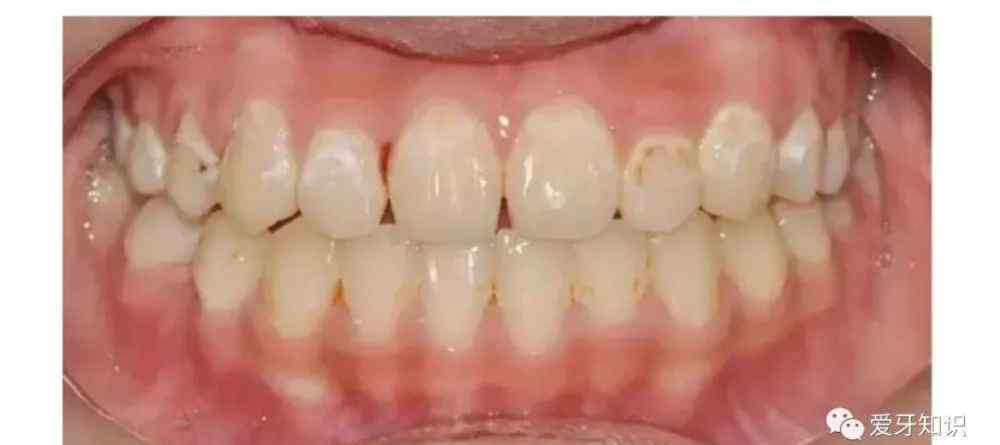 门牙上有白斑图片 一看吓一跳，牙齿上居然长白斑？要怎么处理？