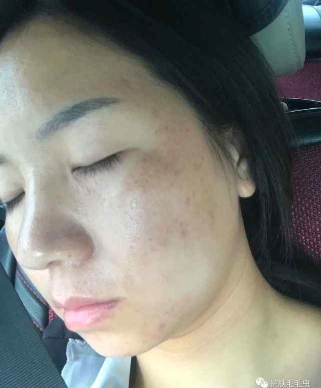 中药去黄褐斑配方 不要烦恼了，黄褐斑的克星找到了，是它！
