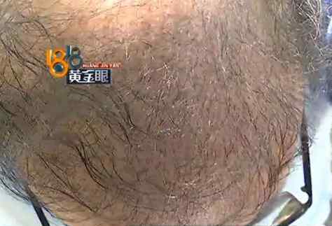 杭州头发种植 杭州一男子的头发种好又脱落 美容诊所：资源不好