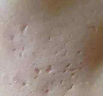 黑色痘印怎么消除 黑色痘印怎么消除？福佑告诉你