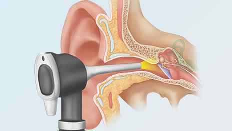 从耳朵看疾病图片 怀疑得了中耳炎，这4项检查来帮你确诊，有耳部疾病的人一定要看！