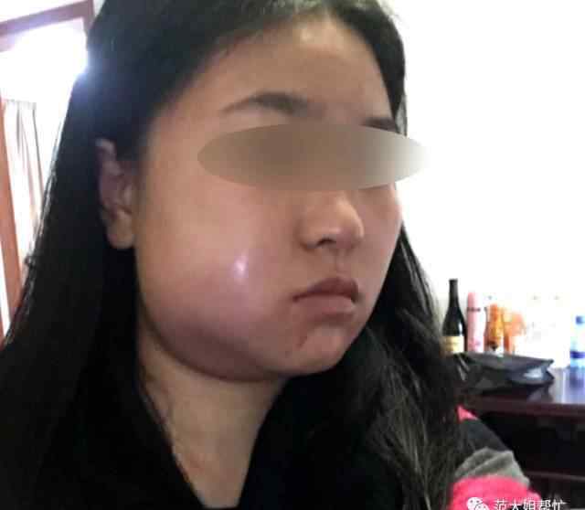 拔智齿脸会变小吗 杭州一姑娘拔了智齿 结果脸变成了“鹅蛋”