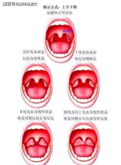 正常扁桃体和发炎图片 扁桃体状态图解 及 扁桃体发炎吃什么好？