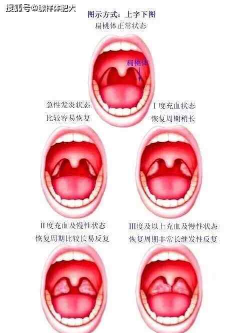 正常扁桃体和发炎图片 扁桃体状态图解 及 扁桃体发炎吃什么好？