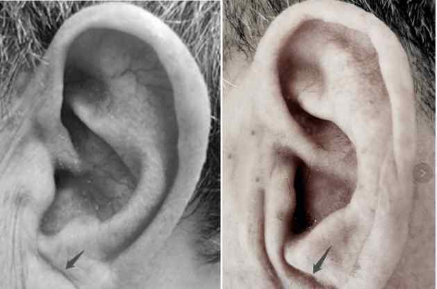 耳朵有折痕预示 “耳朵褶皱”是冠心病迹象？符合这5点的人心脏更危险