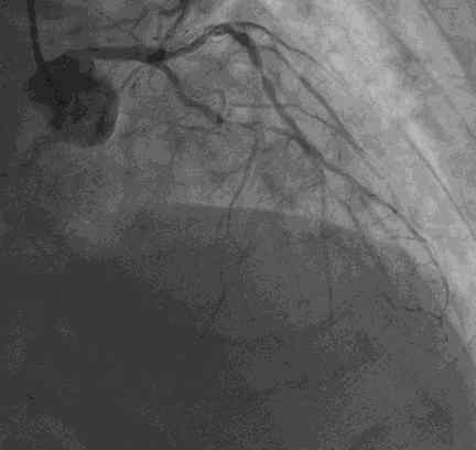 pci 冠状动脉介入手术（PCI）
