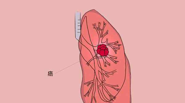 肺癌咳嗽特点 咳嗽是小病？呼吸科医生：满足3个特点，也许是肺癌的征兆