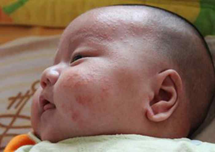 一个月宝宝脸上长了很多小红点 新生儿脸上长小红点、小白点是怎么回事？