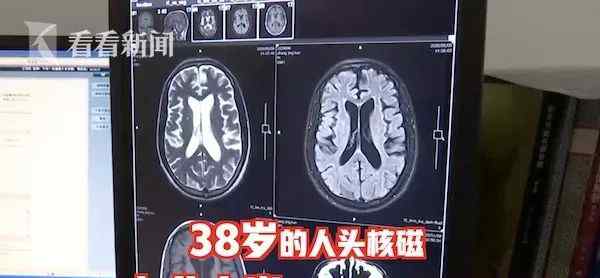 北京藏医院男性专科 38岁男子被查出“痴呆晚期”？罪魁祸首让人意想不到