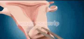 避孕环避孕原理动画 3D动画演示产妇生孩子后上环全过程, 看着都疼！