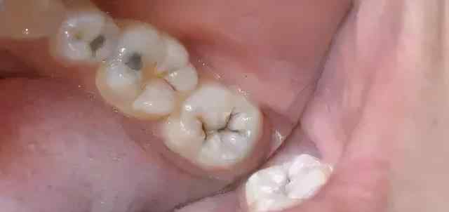 牙齿中间有黑的是怎么回事 牙齿上有很多小黑点，不疼也不痒是怎么回事？告诉你背后的隐患