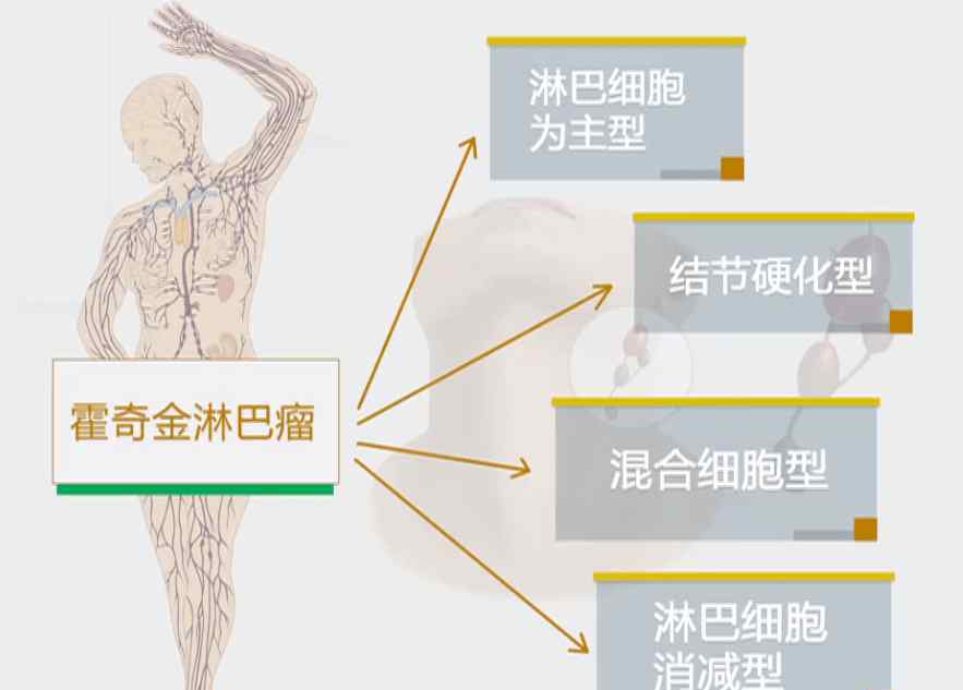 淋巴癌最后是怎么死亡 30岁的熊顿因淋巴瘤不幸去世！淋巴瘤究竟是怎么回事？能被治愈吗？