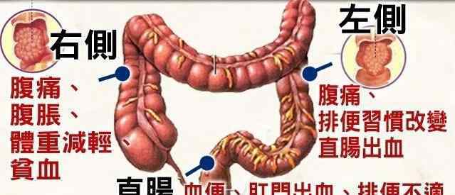 大便不成形是怎么回事 辟谣！大便不成形一定是肠癌吗？别慌，医生告诉你怎么办