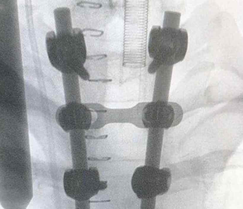 90后男子做俯卧撑致下身瘫痪 到底发生了什么