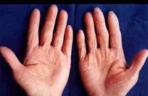角化增厚型手癣 十大常见皮肤病之八：手癣与足癣