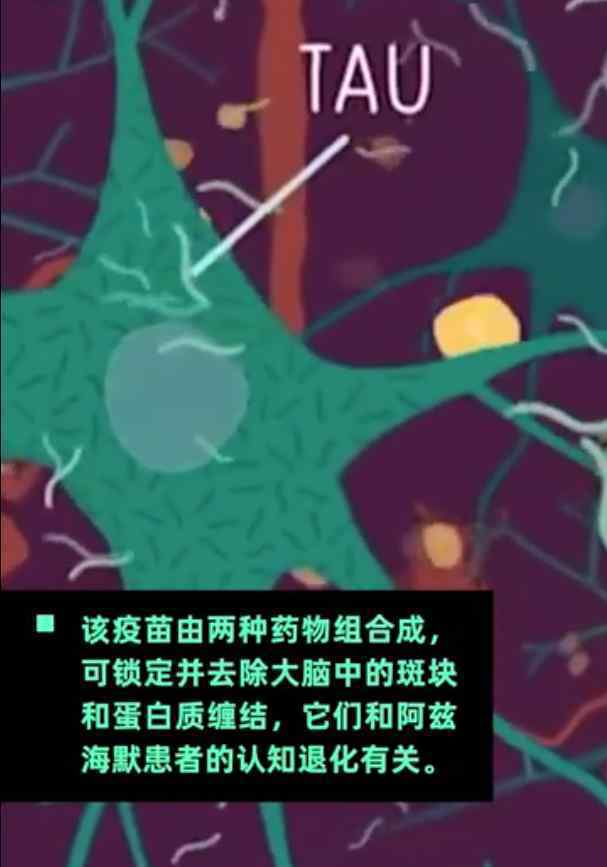 阿兹海默疫苗将进入人体临床阶段 希望能尽早研究出来