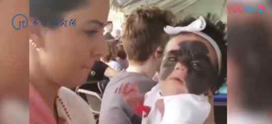 女婴自带蝙蝠侠面具  什么情况罕见皮肤疾病（图）