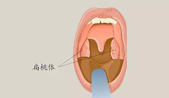 扁桃体炎图片 【扁桃体要“发言”】为什么发炎的总是我......