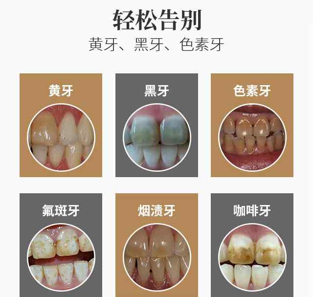 美白牙齿的产品 市面上的牙齿美白产品哪些能够真的美白牙齿呢？