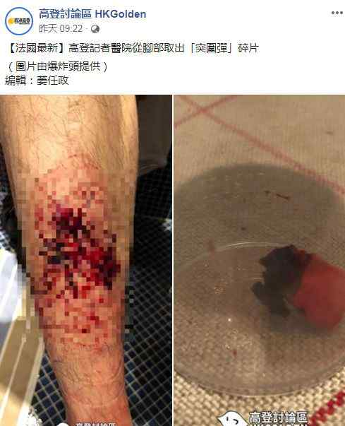 香港高登网 香港反对派记者被法国警察“炸伤”，网友提醒港警的“好”