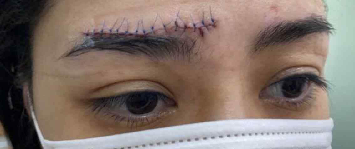 阿娇受伤后首次晒伤口照片 究竟发生了导致额头受伤