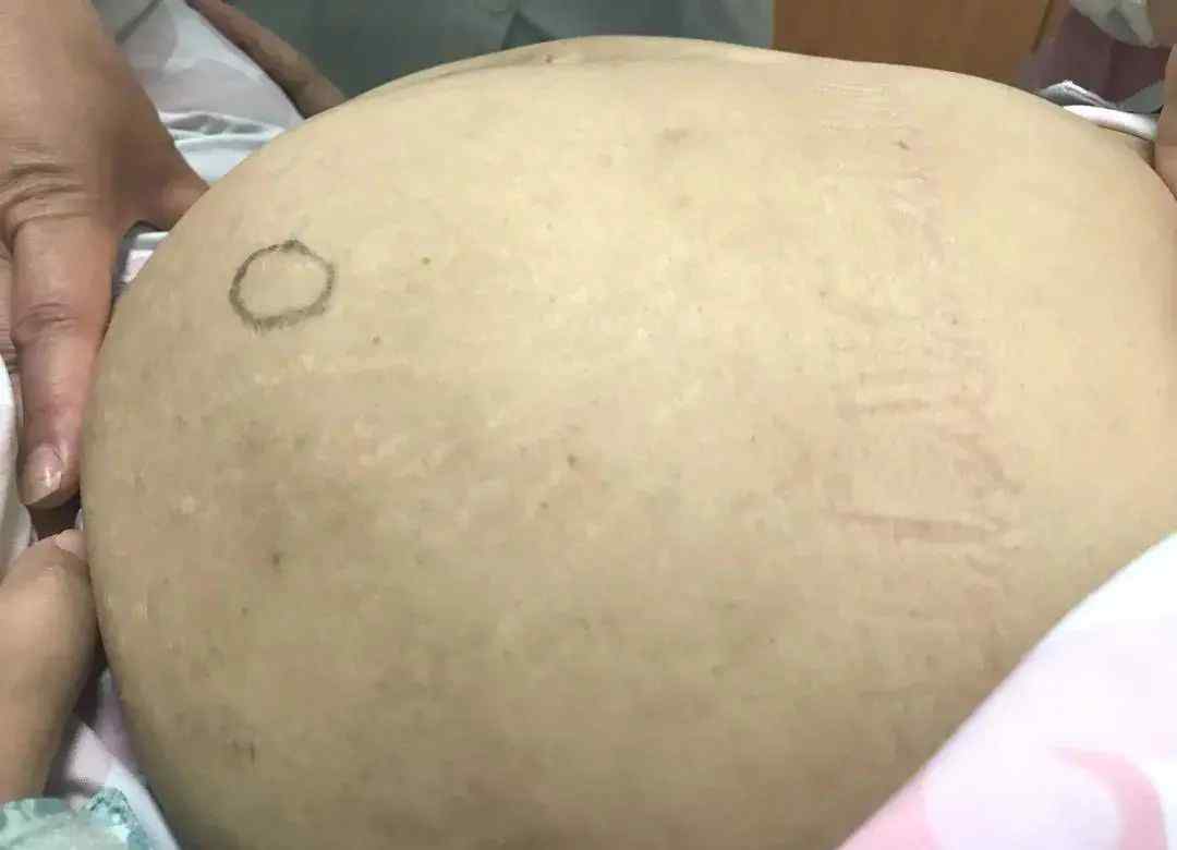 女子腹大如怀胎8月 医生取出一8斤重的“怪东西”