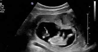怀孕5个月胎动频繁正常吗 怀孕五个月，晚上胎动得特别厉害，这是怎么回事？