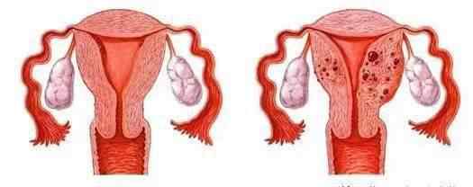 子宫肌瘤的早期症状有哪些 子宫肌瘤早期症状都有哪些？