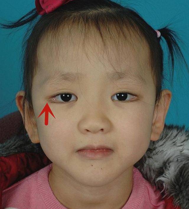 歌舞伎综合症宝宝照片 孩子睫毛太密太翘，长得太漂亮像洋娃娃，医生：太漂亮有可能是病