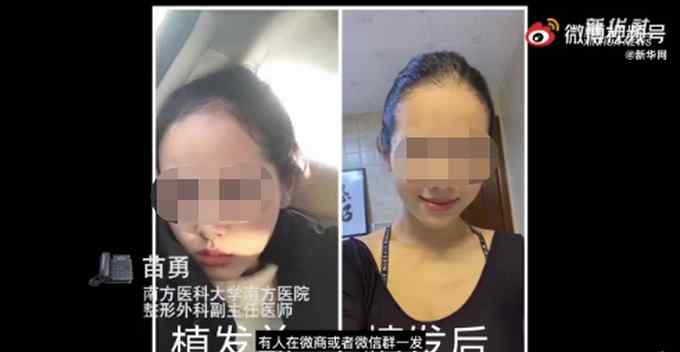 90后女孩花3万植发 一照镜子当场崩溃