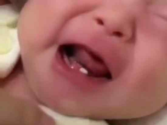 女婴出生长两颗牙 为什么刚出生就有牙详细情况