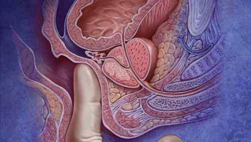 腺癌是什么病 前列腺癌是种什么病？