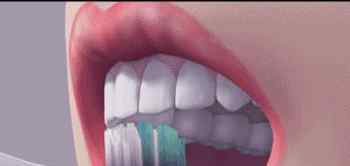 门牙蛀牙 很多人牙上都有黑缝，那不是蛀牙吗？
