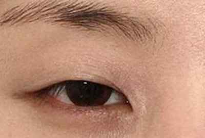 眼肌无力 什么是眼睛重症肌无力?