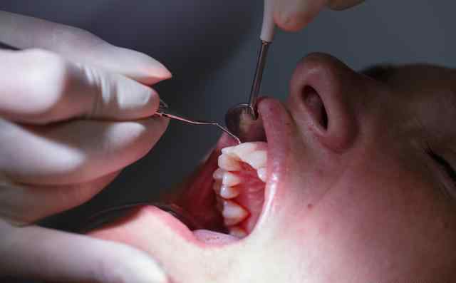 甲硝唑片治牙周炎 牙周炎常用治疗药物（附联合用药）